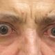 Όραση και Θυρεοειδής - Θυρεοειδική οφθαλμοπάθεια ('Νόσος Graves')